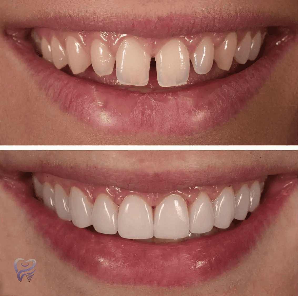 dental_veneers