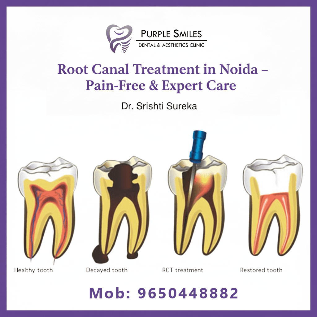 Root-Canal-Treatment-Noida