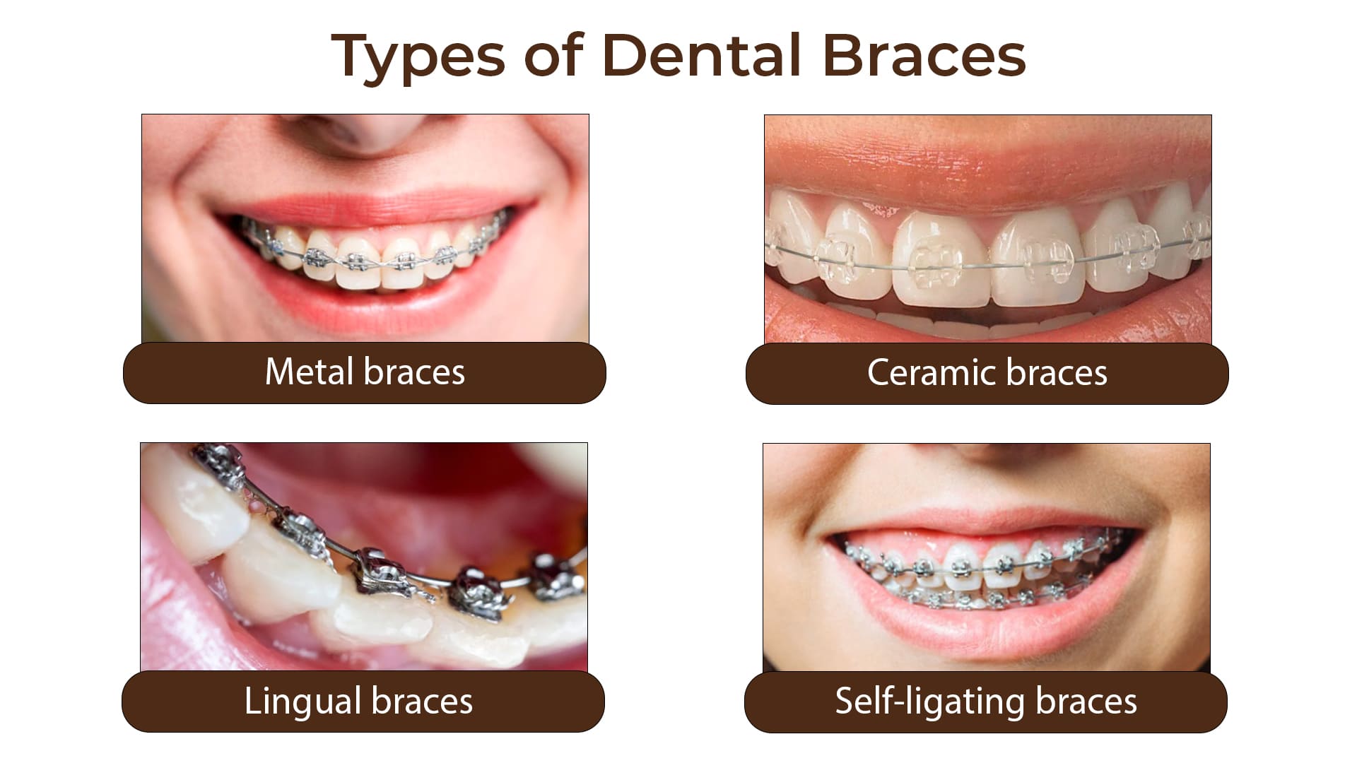 Types-of-Dental-Braces-in-Noida