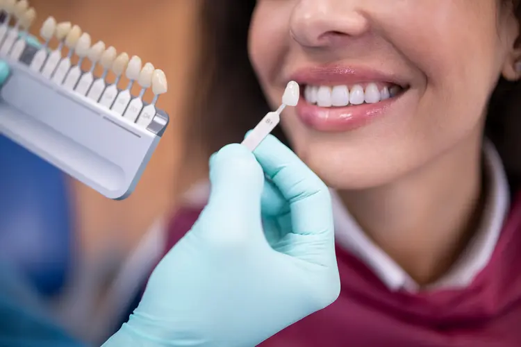 dental_veneers