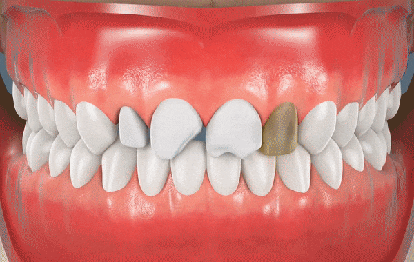 Veneers Near Me